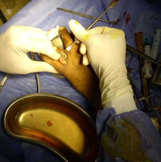 مسعود إجراء عملية جراحية لعظام اليد بمستشفي الزقازيق العام